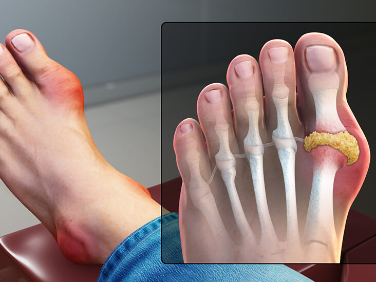 Gout_Signs_and_Symptoms_thumb-732x549