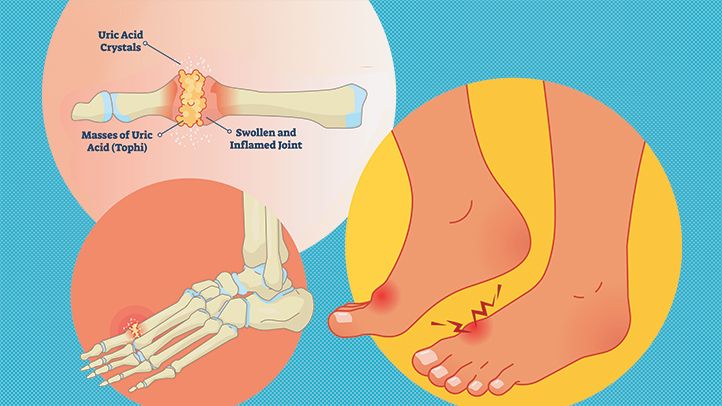 american-college-of-rheumatologists-issues-new-guidelines-on-gout-treatment-722x406