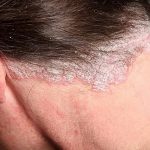 Vẩy nến da đầu: Nguyên nhân và cách điều trị