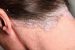 Vẩy nến da đầu: Nguyên nhân và cách điều trị