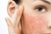 Da mặt bị dị ứng và những cách xử lý đơn giản tại nhà